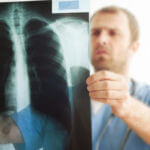 Do I Qualify for Disability With Mesothelioma? article image