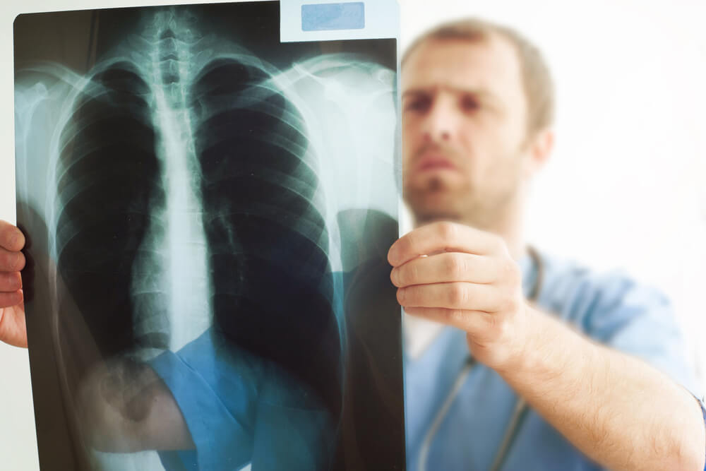 Do I Qualify for Disability With Mesothelioma? article image