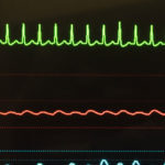 How to Qualify for Disability with SVT (Supraventricular Tachycardia)