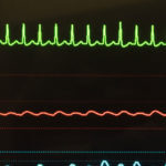 How to Qualify for Disability with SVT (Supraventricular Tachycardia)