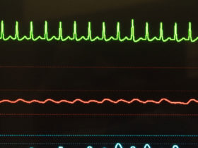 How to Qualify for Disability with SVT (Supraventricular Tachycardia)