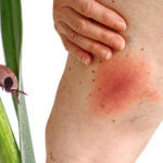 Can I Get Disability Benefits for Lyme Disease?