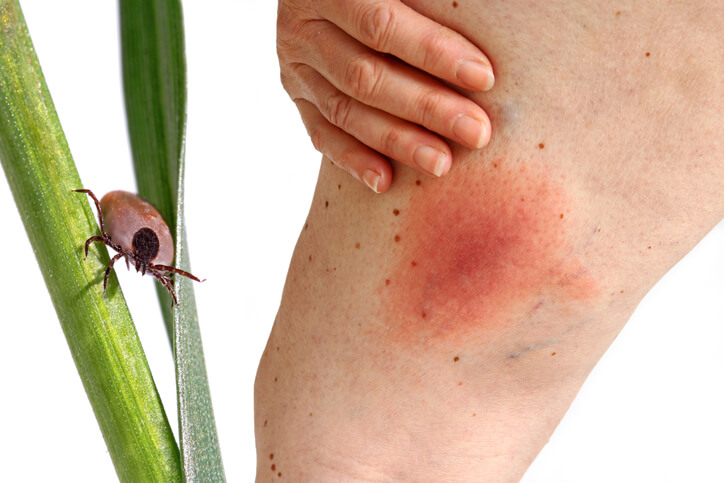 Can I Get Disability Benefits for Lyme Disease?